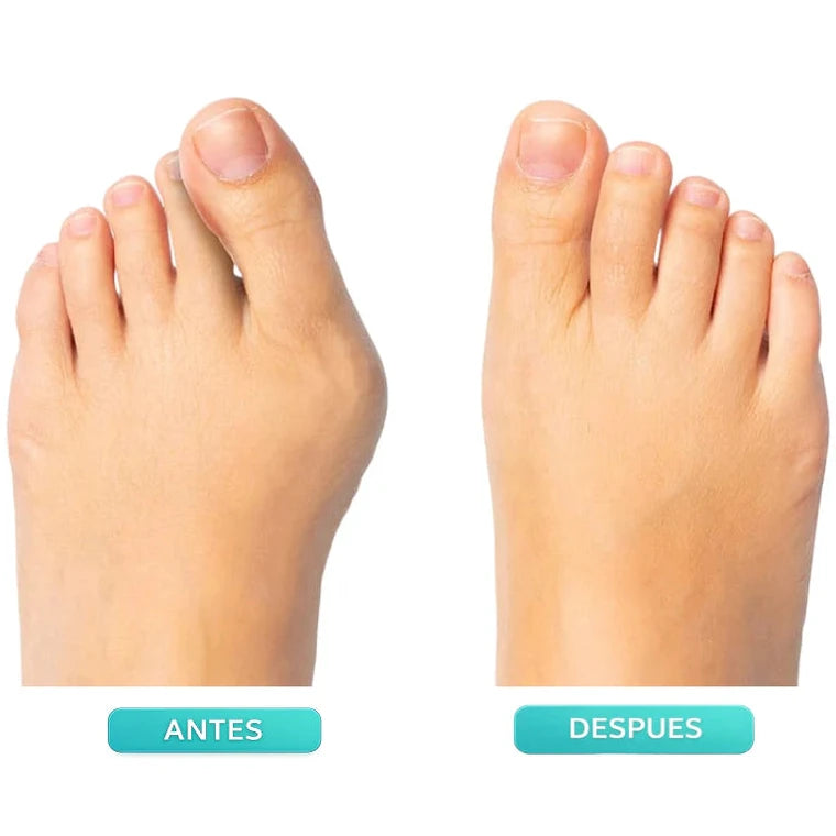 Corrector Ajustable para Juanetes - Imagen 2