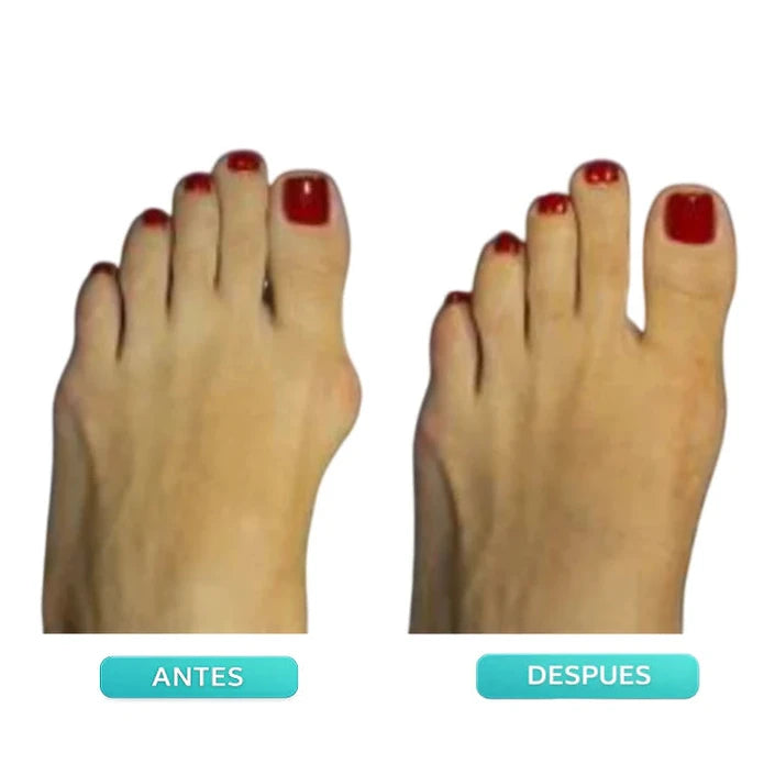 Corrector Ajustable para Juanetes - Imagen 3